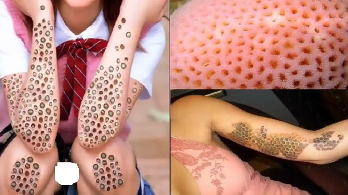 Nah, Ini Cara Mudah Atasi Penyakit Trypophobia