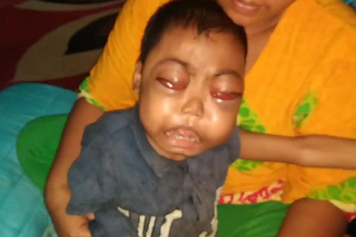 Isron, Bocah Penderita Leukimia di Sarolangun Kembali dari Pengobatan di Padang, Ini Kondisinya