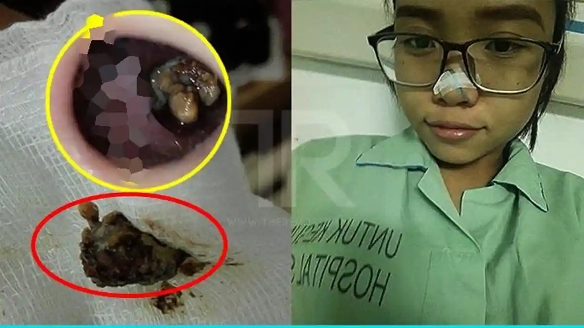 Wanita Ini Selalu Mencium Bau Bangkai Rupanya Ada Benda Tak Terduga di Dalam Hidungnya