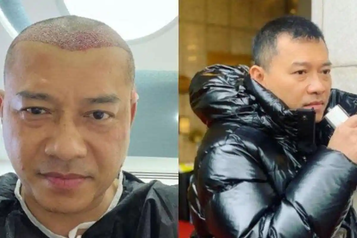 Anang dan Atta Lakukan Transplantasi Rambut, Ternyata Biayanya Mencapai Rp 22 Juta hingga Rp 53 Juta