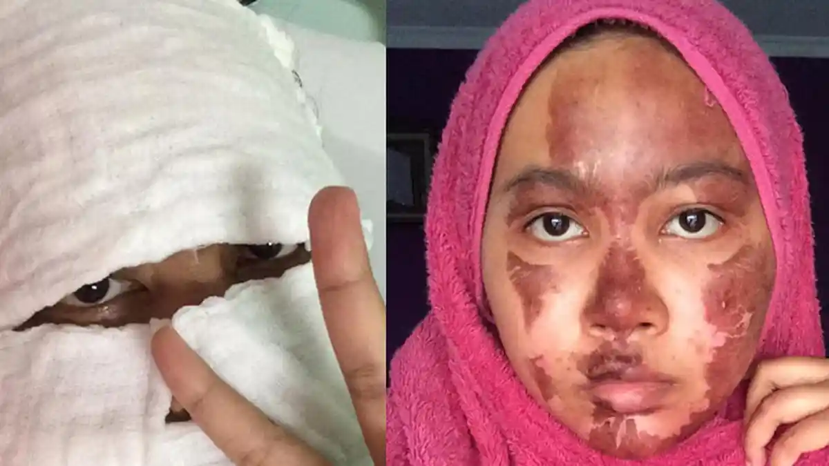 Wajahnya Terbakar, Wanita Ini Bagikan Pengalaman Buruk Pakai Panci Presto