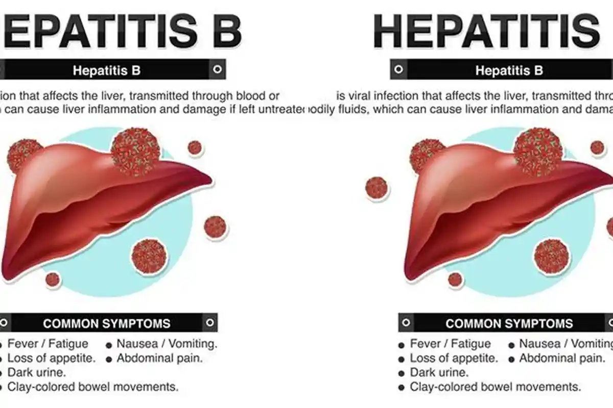 Bisa Samar, Berikut Tips Mengetahui Gejala Hepatitis B