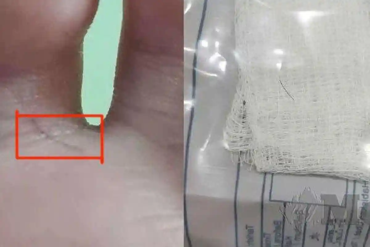 Dokter Bedah Dikejutkan dengan Penemuan Aneh, di Kaki Bocah Ada Sehelai Rambut Bergerak Sendiri