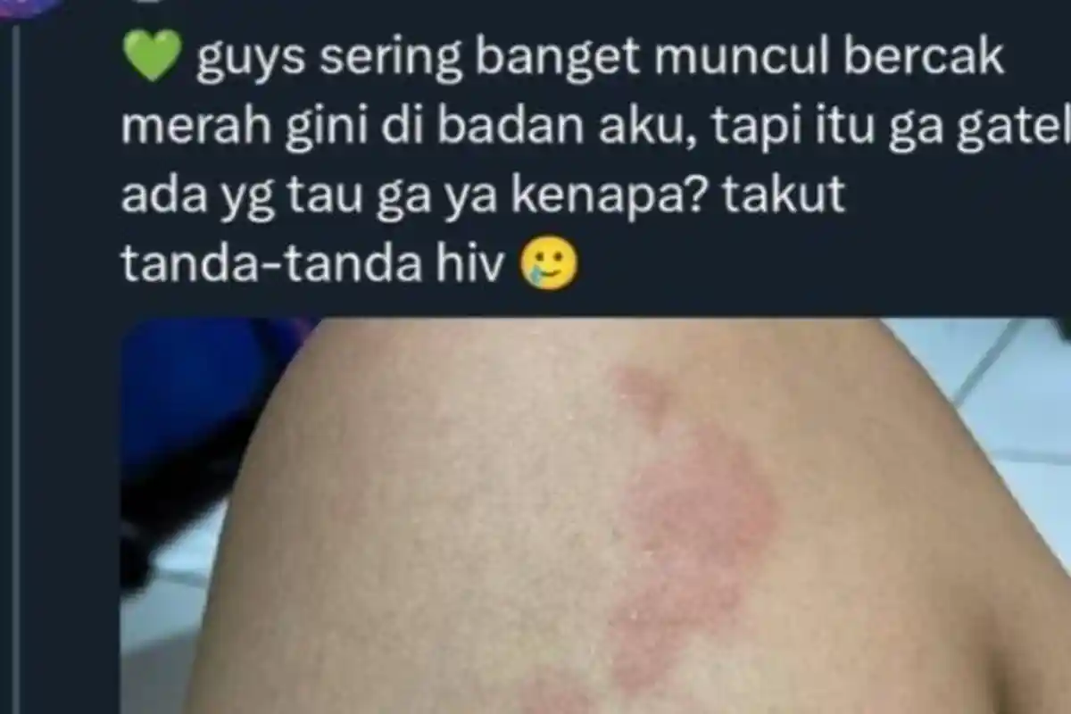 Viral Warganet Curhat Takut HIV gegara Sering Muncul Bercak Merah di Badan, Begini Penjelasan Dokter