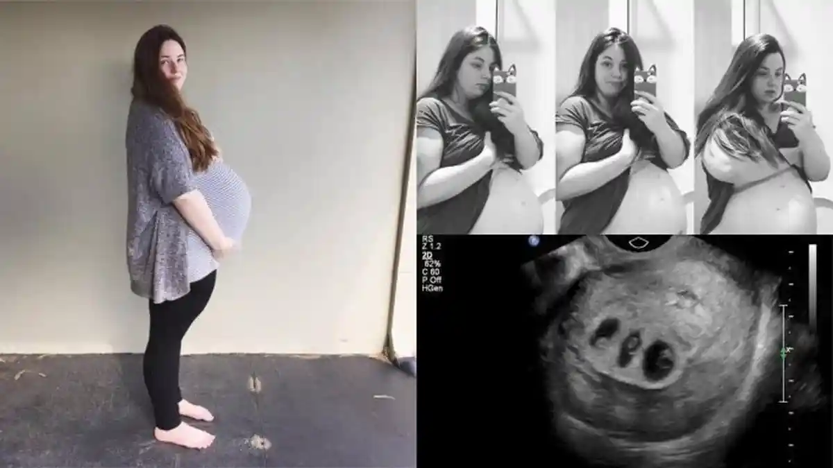 Hamil Kembar 3, Ibu Ini Diminta Korbankan 1 Anak. Tak Disangka, Begini Keputusannya