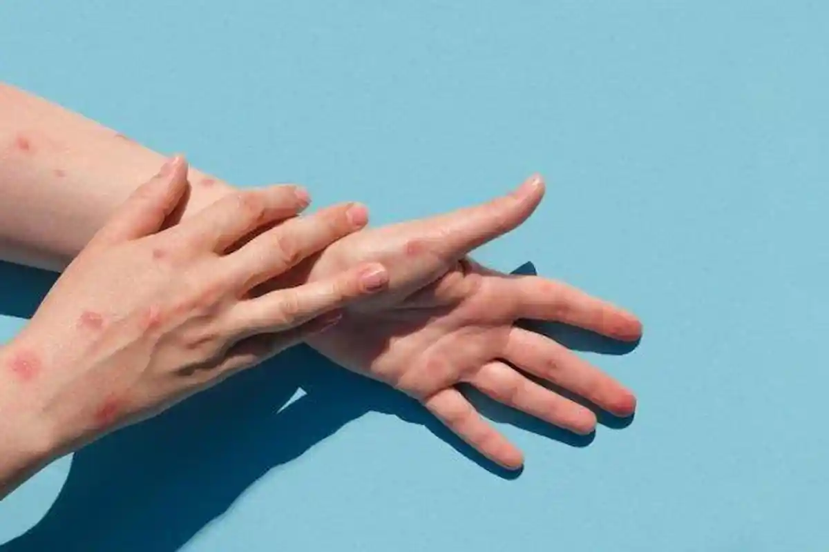 Waspada Kasus Mpox, Begini Cara Mencegah Penularan Cacar Monyet antar Manusia