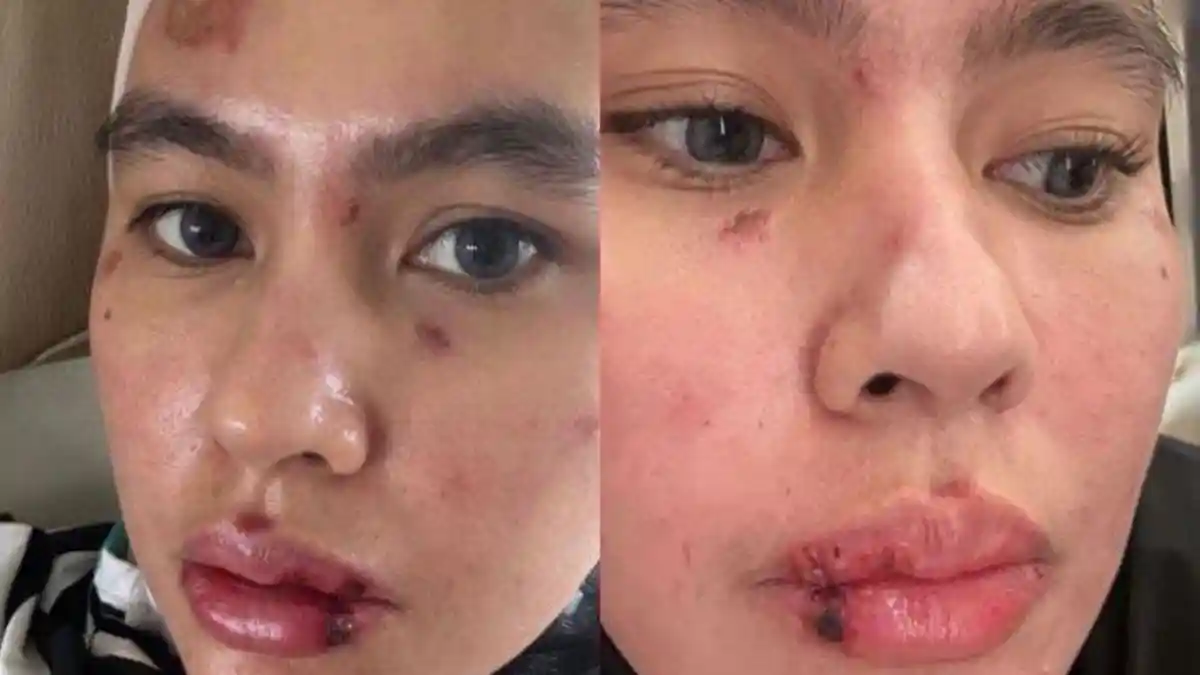 Pilunya Kartika Putri, Wajah dan Lidahnya Melepuh Tapi Malah Dinyinyirin, Ada Sampai Bilang Karma