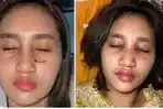 implan-hidung-tribunmedan1.jpg
