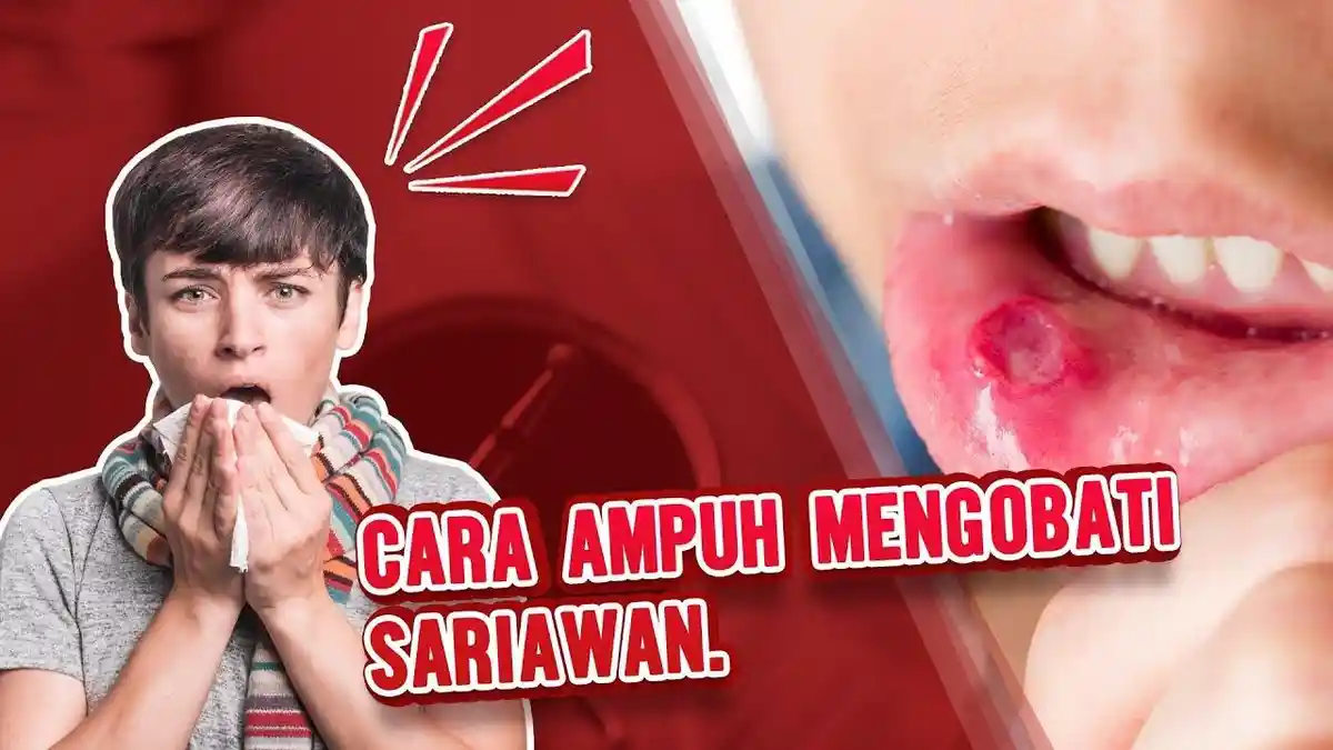 5 Cara Mudah Sembuhkan Bibir Sariawan dengan Cepat, Hanya Menggunakan Bahan-bahan Alami