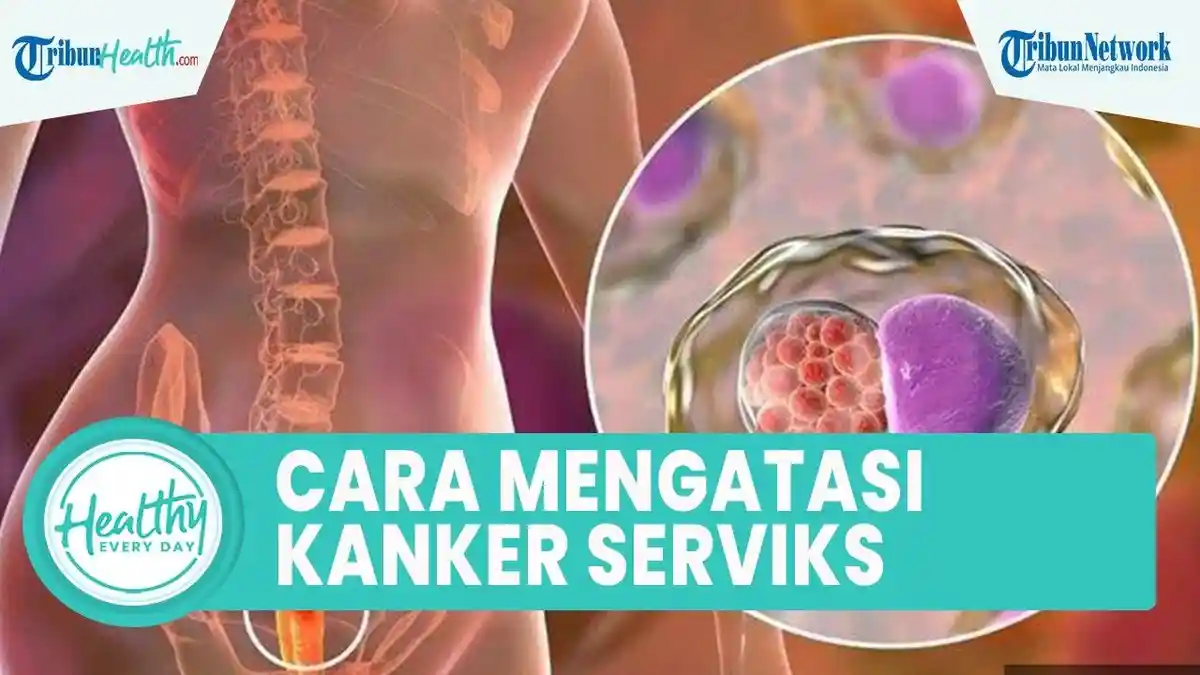 5 Cara Mengobati Kanker Serviks Operasi, Kemoterapi, Terapi Radiasi, Dijamin Sembuh!