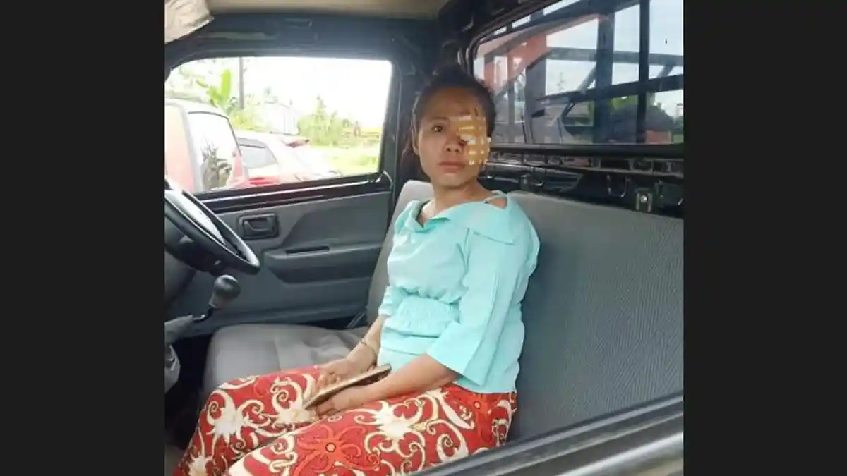 Wanita Jadi Korban Pertengkaran Sepasang Kekasih di Warung Tuak, Wajahnya Dapat 20 Jahitan