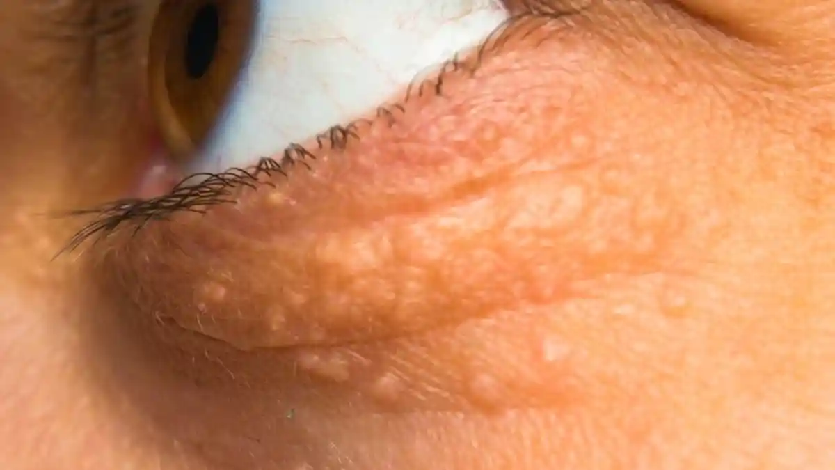 Tanda Kolesterol Tinggi di dalam Tubuh, Kenali Apa Itu Xanthelasma