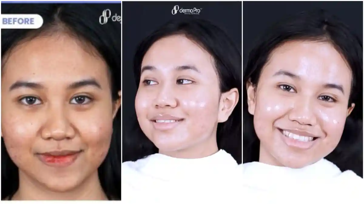 'Aku Sering Insecure' Curhat Mayang Sering Dicibir Teman & Dibully, Kini Perawatan Wajah Rp 50 Juta