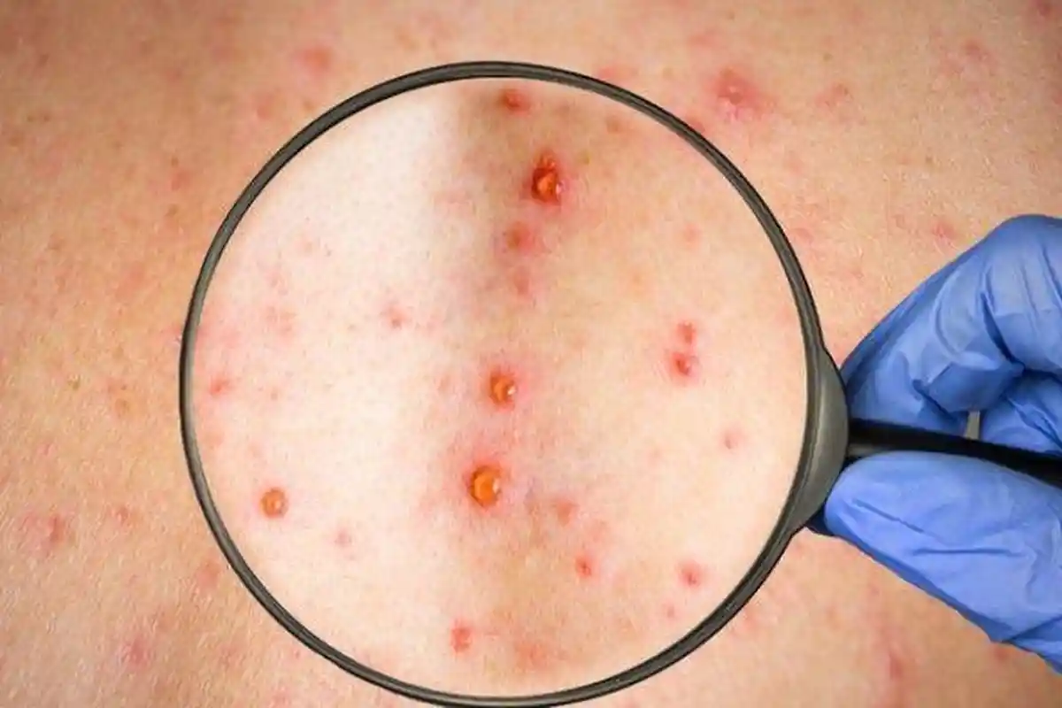 Mengenal Gejala Cacar Monyet pada Tubuh, Kini Lebih dari 1.000 Kasus Monkeypox