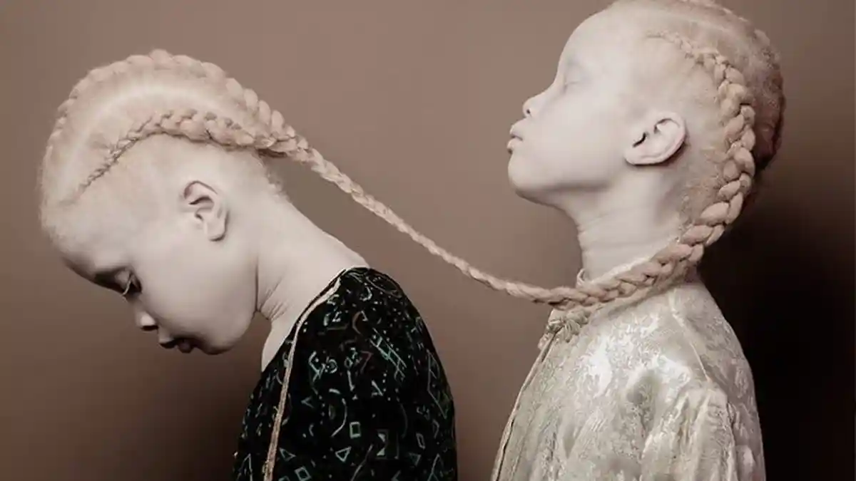 Kembar Albino, 2 Gadis Cilik Ini Tunjukkan Kecantikannya dengan Cara yang Unik!