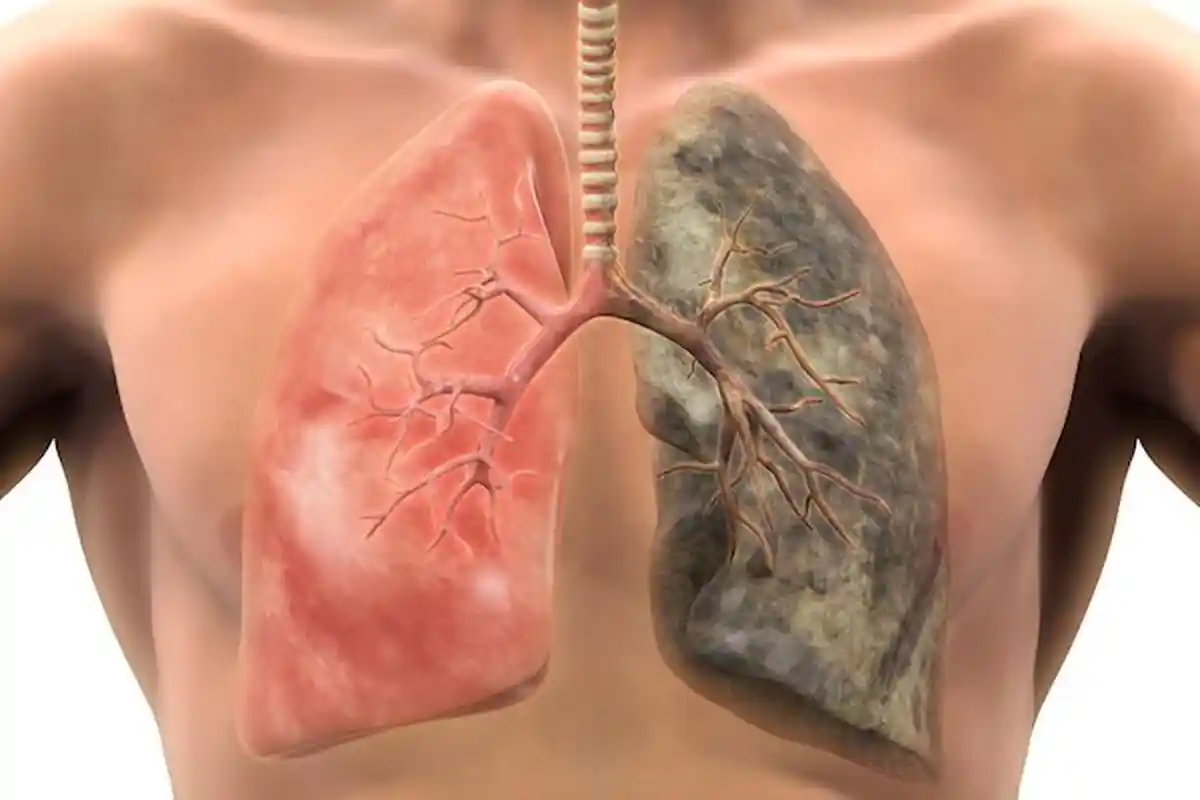 Dokter Onkologi Toraks Ungkap Penyebab Kanker Paru Bisa Jangkiti Pasien Usia Muda