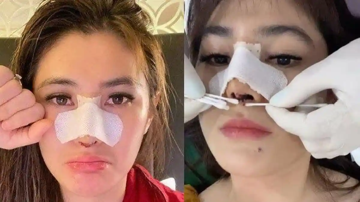 Implan Hidung Pecah, Kini Artis Cantik Ini Ngaku Menyesal Lakukan Operasi Plastik, Begini Kondisinya