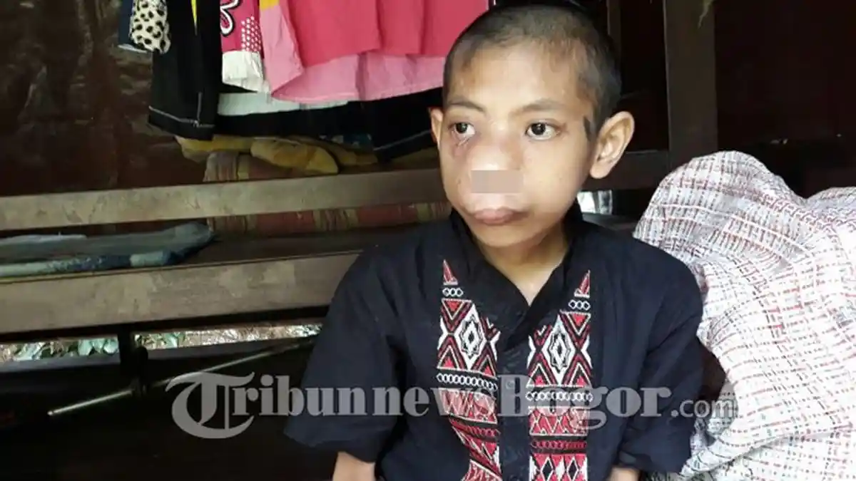 Digerogoti Tumor Ganas, Anak Ini Setiap Hari Kesulitan Bernafas