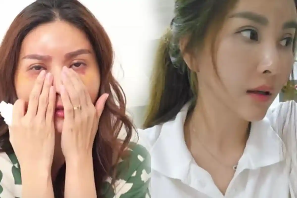 Biaya Operasi Plastik Sarwendah di Korea Selatan Gak Main-main, Istri Ruben Onsu: Pemindahan Lemak