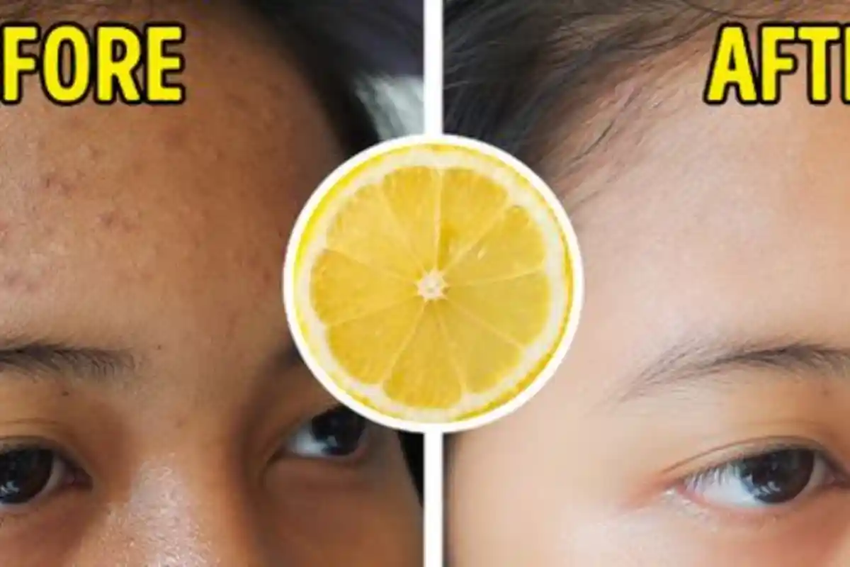 7 Makanan yang Dapat Mengurangi Luka Bekas Jerawat, Labu Hingga Quinoa