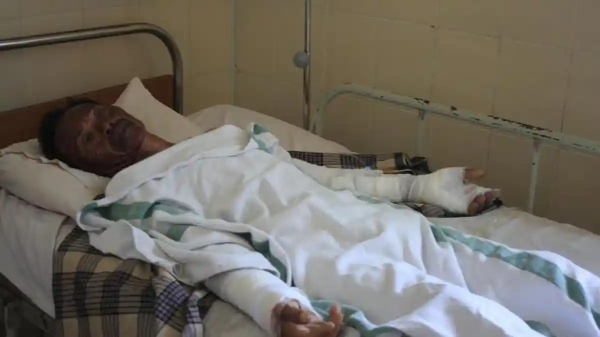 Tab­ung Gas Bocor, Pasangan Suami Istri Ini Terbakar