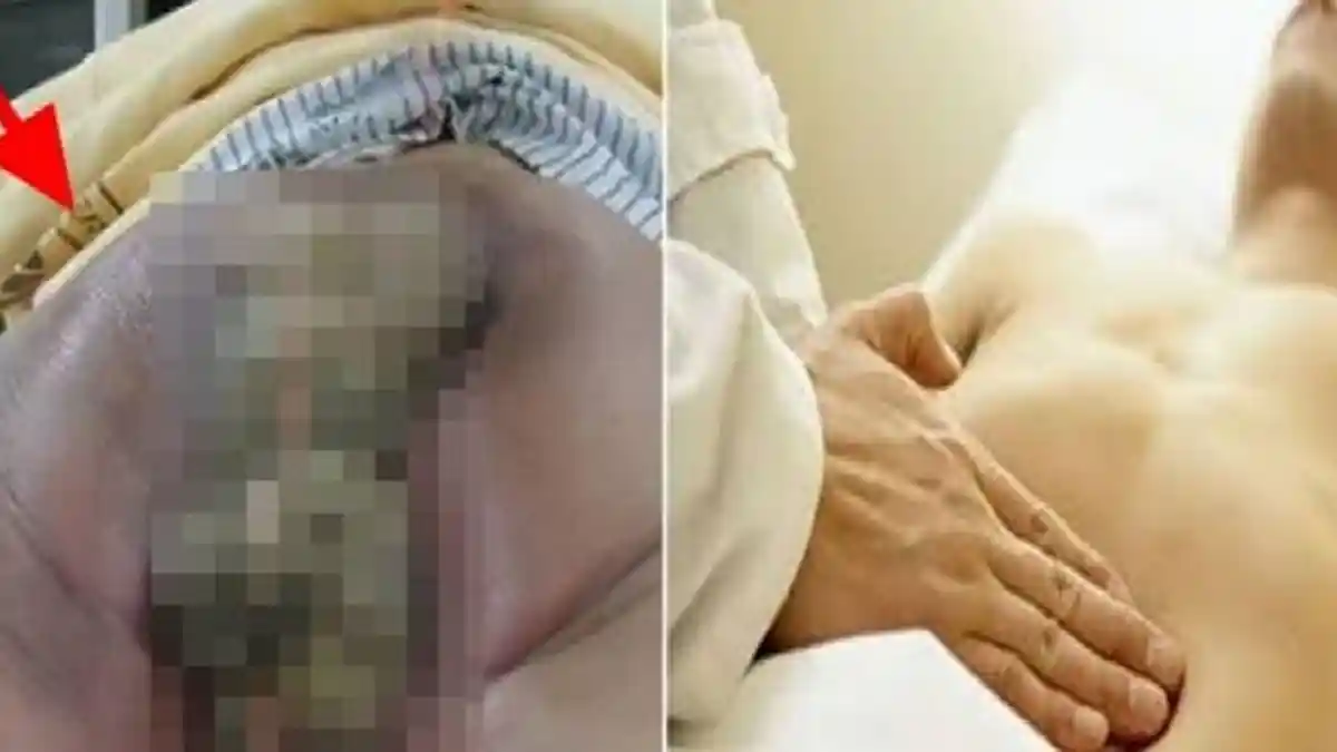 Pria Keras Kepala Ini Tolak Pengobatan Dokter,Akibatnya Perut Mengeluarkan Benda Ini,Bau Ikan mati!