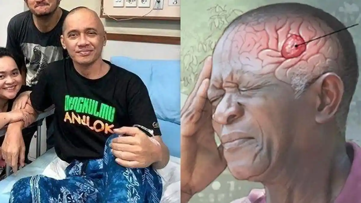 Positif Mengidap Kanker Otak Stadium 4, Agung Hercules Tak Pernah Cerita ke Teman-Temannya