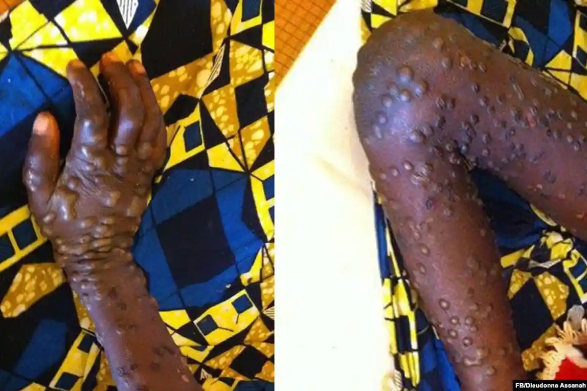 Cacar Monyet Ditetapkan Jadi Darurat Kesehatan Global, Lebih dari 16 Ribu Kasus Muncul di 75 Negara