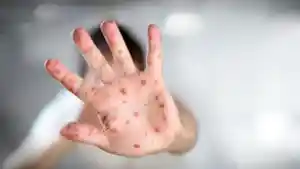 WASPADA-Penyakit-Cacar-Monyet-atau-Monkeypox-yang-Jadi-Perhatian-WHO-Ini-Bedanya-dengan-Covid-19.jpg