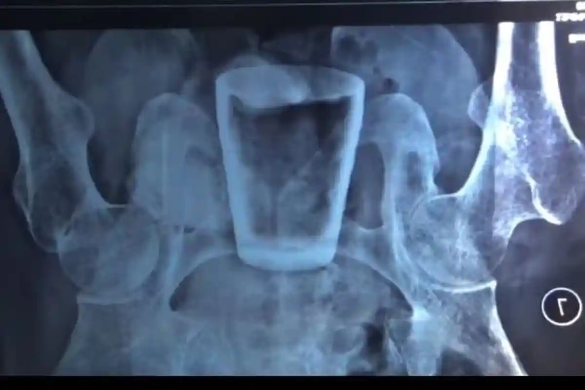 Aneh tapi Nyata Gelas Kaca dalam Perut Pria di Jember, Rumah Sakit Beri Penjelasan Asal Muasalnya