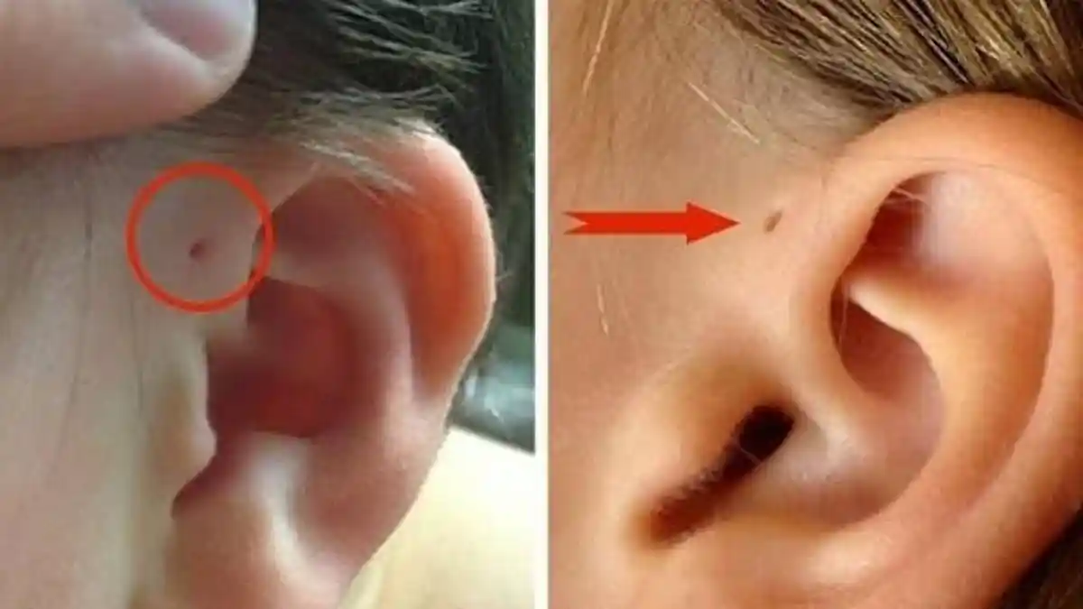 Perhatikan Lubang Kecil di Atas Daun Telinga? Jika Ada, Ternyata Ini Penjelasan Ini Tanda Itu
