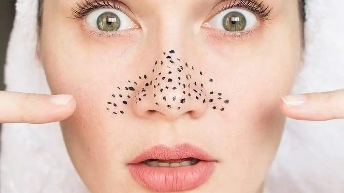 11 Cara Menghilangkan Komedo yang Kadang Bikin Kita Enggak Pede