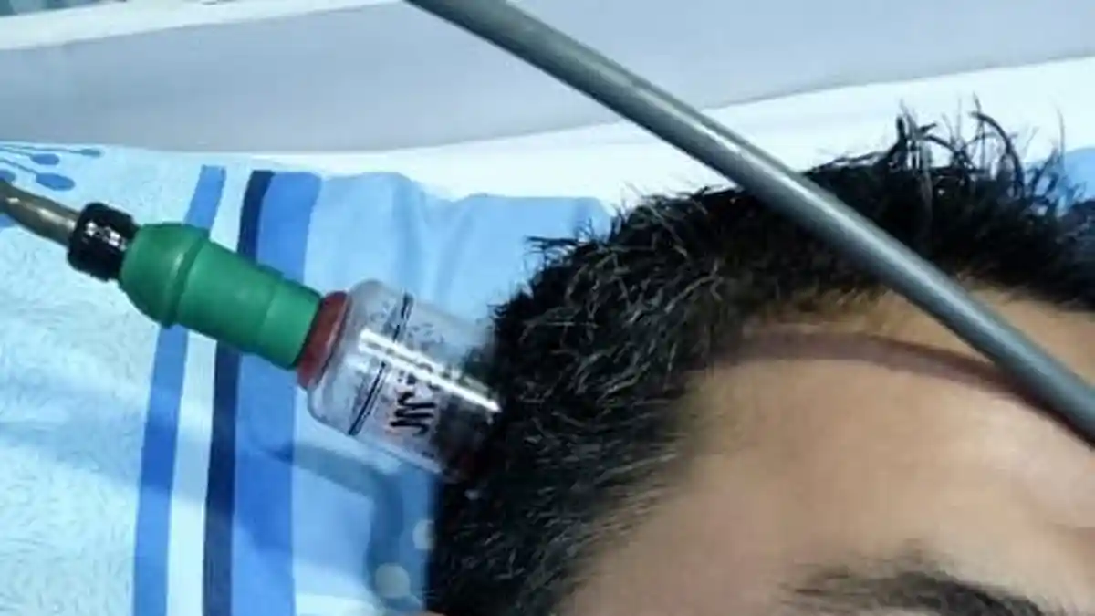 Pangkas Biaya Miliaran dengan Terapi, Keluarkan Racun Melalui Pengobatan Bekam