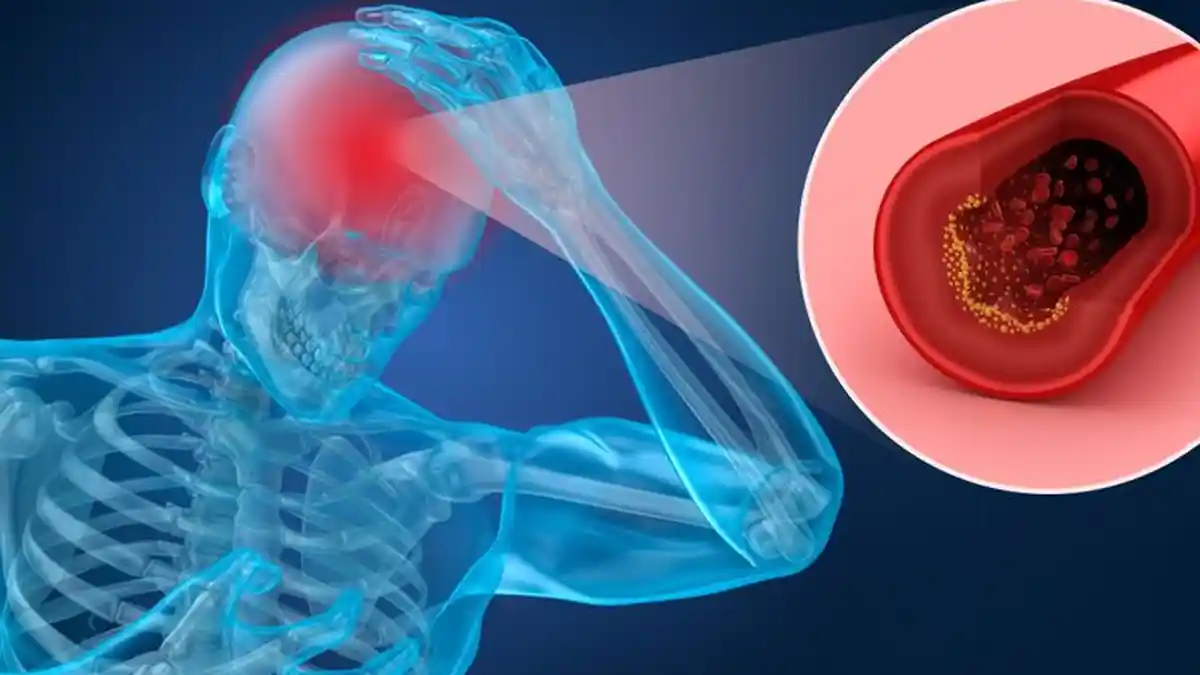 Gejala Stroke Pria dan Wanita ! Apa Saja Gejala Stroke Awal ?