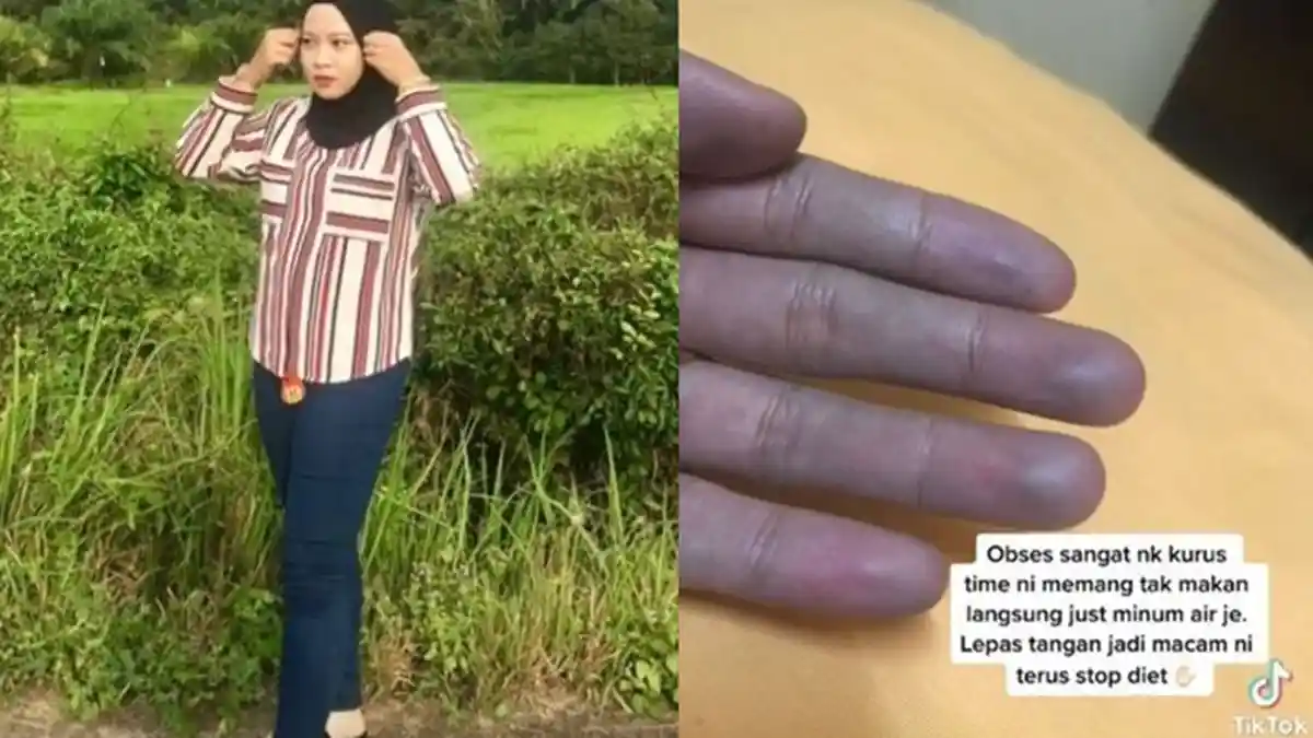 Viral Gadis Ini Diet Ekstrem Hanya Minum saat Lapar, Langsung Kapok Begitu Lihat Kondisi Tangannya