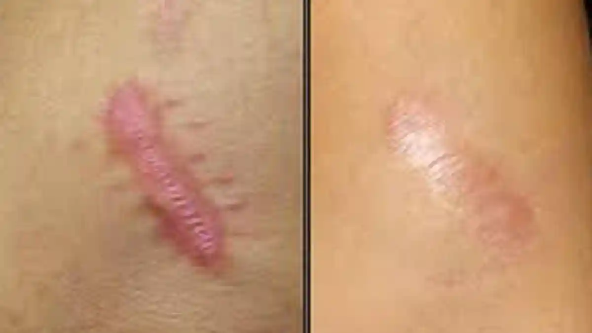 Penanganan Bekas Luka Jadi Keloid, Begini Cara Menghilangkannya