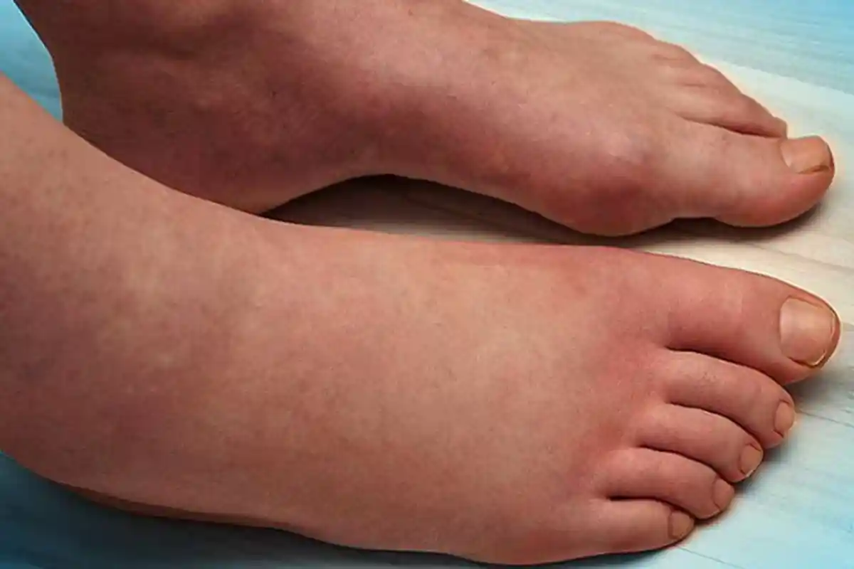 Kaki Bengkak karena Keseleo? Obati dengan Cara Rumahan Ini