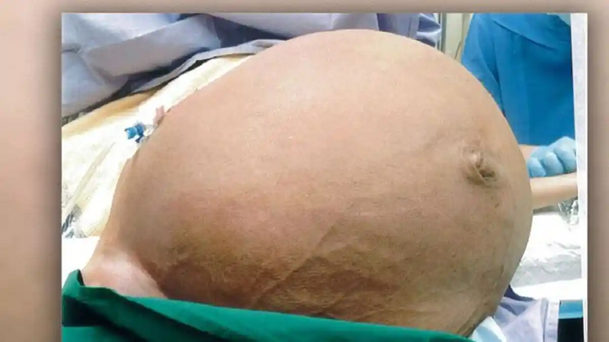 Perempuan Ini Kesulitan Bernapas, Ternyata Ada Tumor Seberat 33 Kg di Rahim