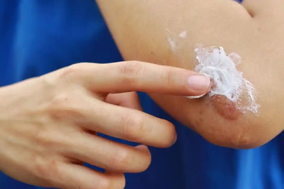 Luka Tak Kunjung Sembuh, Bisa Jadi Anda Mengidap Penyakit Ini