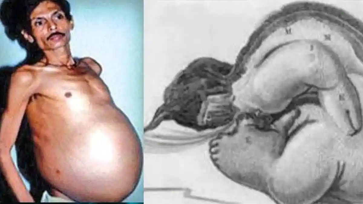 Perut Buncit Mengembang, Pria 'Hamil' di India, 36 Tahun Mengandung Kembaran, Kasus Langka Medis!