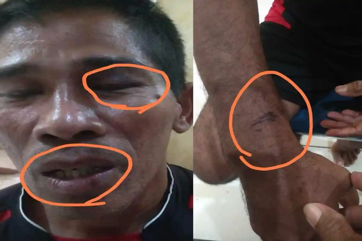 Mata Lebam dan Bibir Pecah, Nus Gororos Diduga Dianiaya Oknum Polisi di Dalam Polres Halmahera Barat