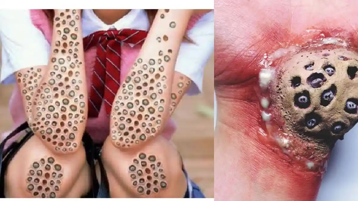 Kalo Anda Merinding Lihat Gambar-gambar Ini Berarti Kena Trypophobia, Begini Cara Sembuhkan