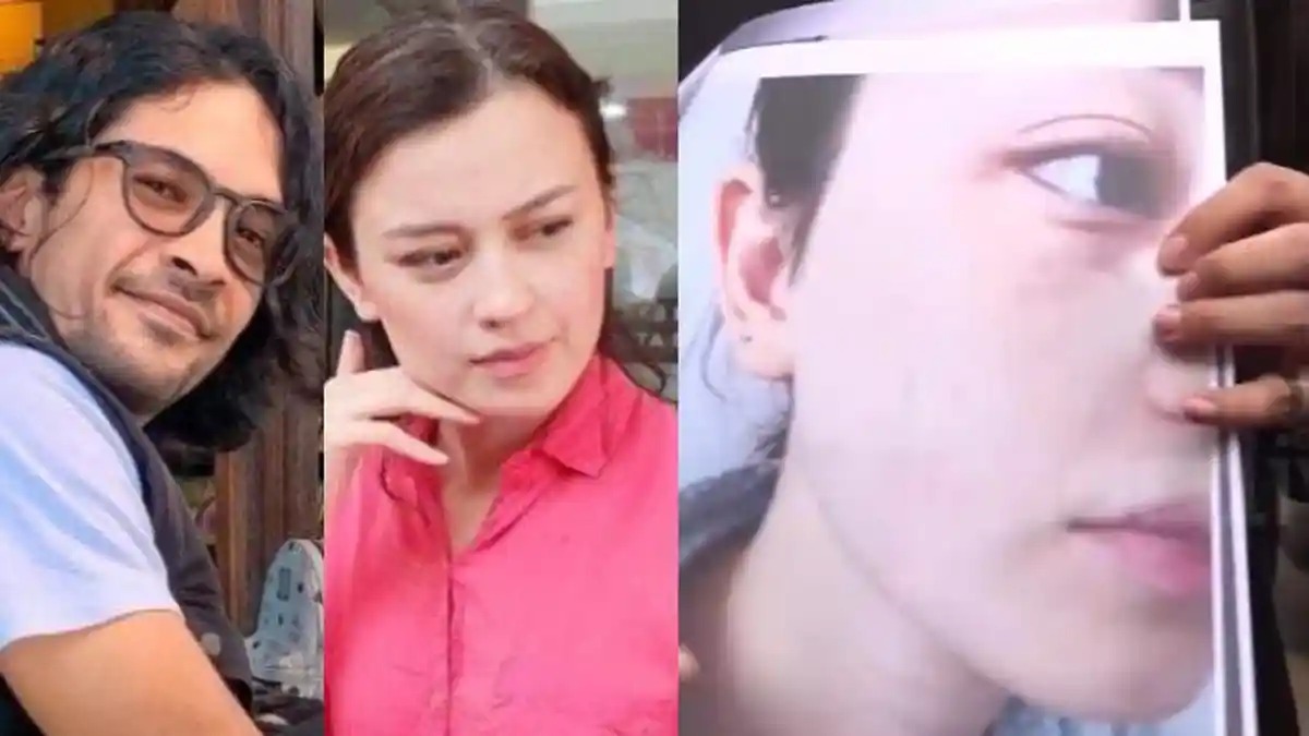 Sebut Alami KDRT oleh Edward Akbar, Kimberly Ryder Punya Bukti, Ada Luka Bekas Tampar hingga Lebam