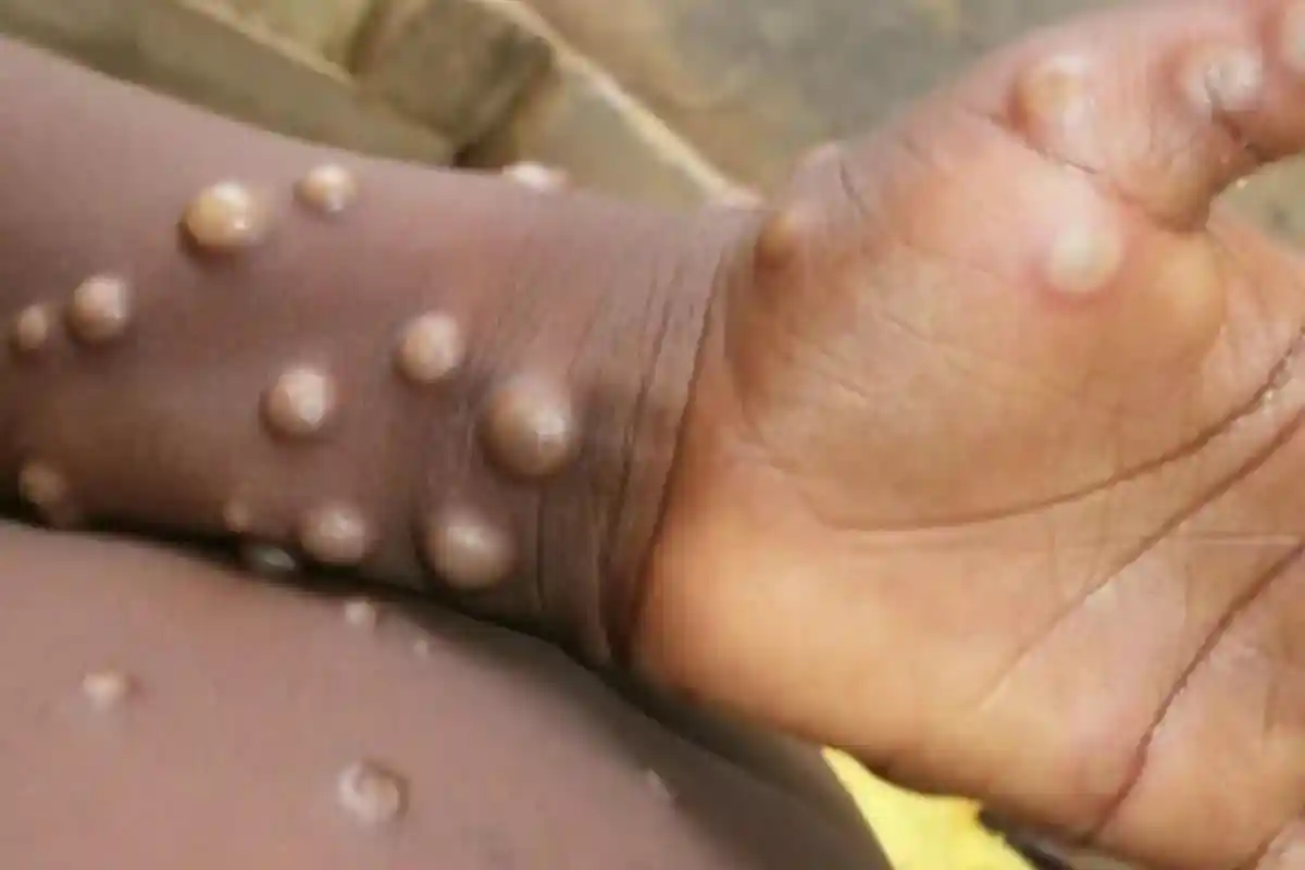 Monkeypox Menyebar, Apakah Ada Negara yang Berlakukan Pembatasan Perjalanan?