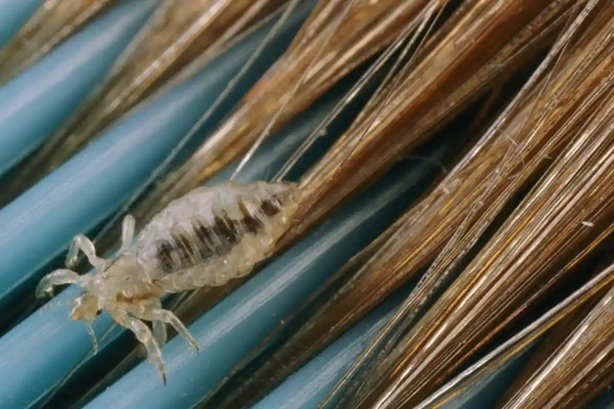 Kenali Cara Penularan Kutu Rambut, Bisa Berpindah dengan Media yang Sering Digunakan Bersama-sama