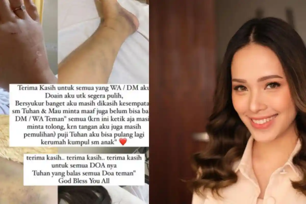 Badan Lady Nayoan Masih Penuh Lebam Pasca Kecelakaan dengan Rendy Kjaernett, Bersyukur Masih Selamat