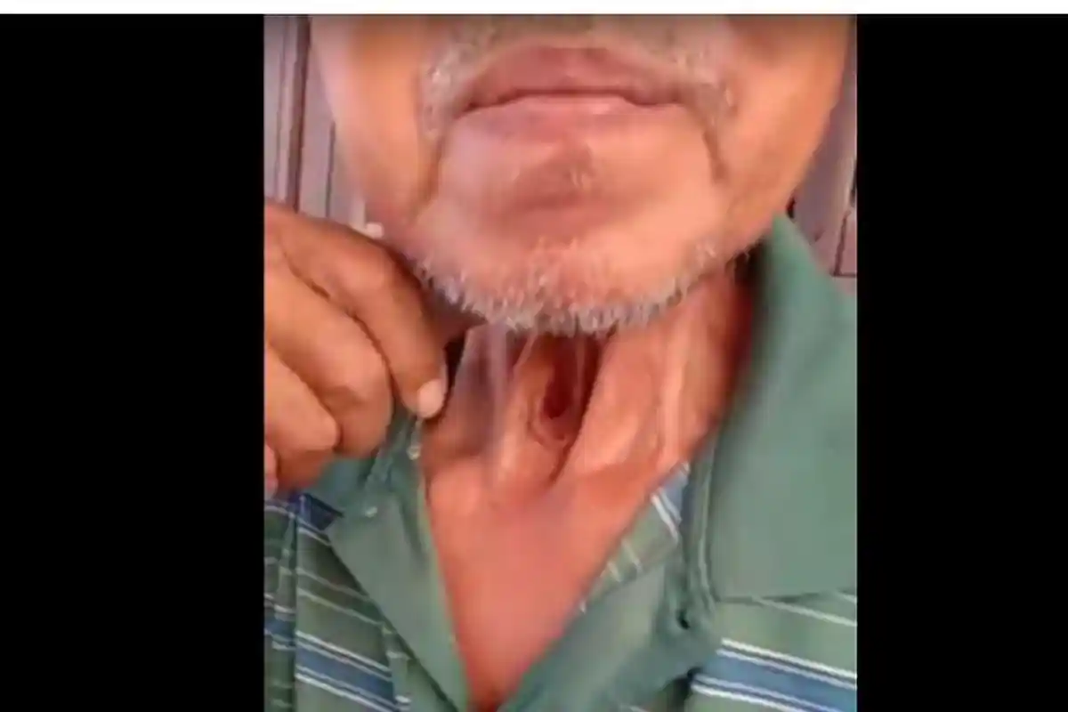 Fakta Video Tenggerokan Berlubang Seorang Bapak Gara-Gara Rokok, Perubahan Suara dan Kata Dokter!