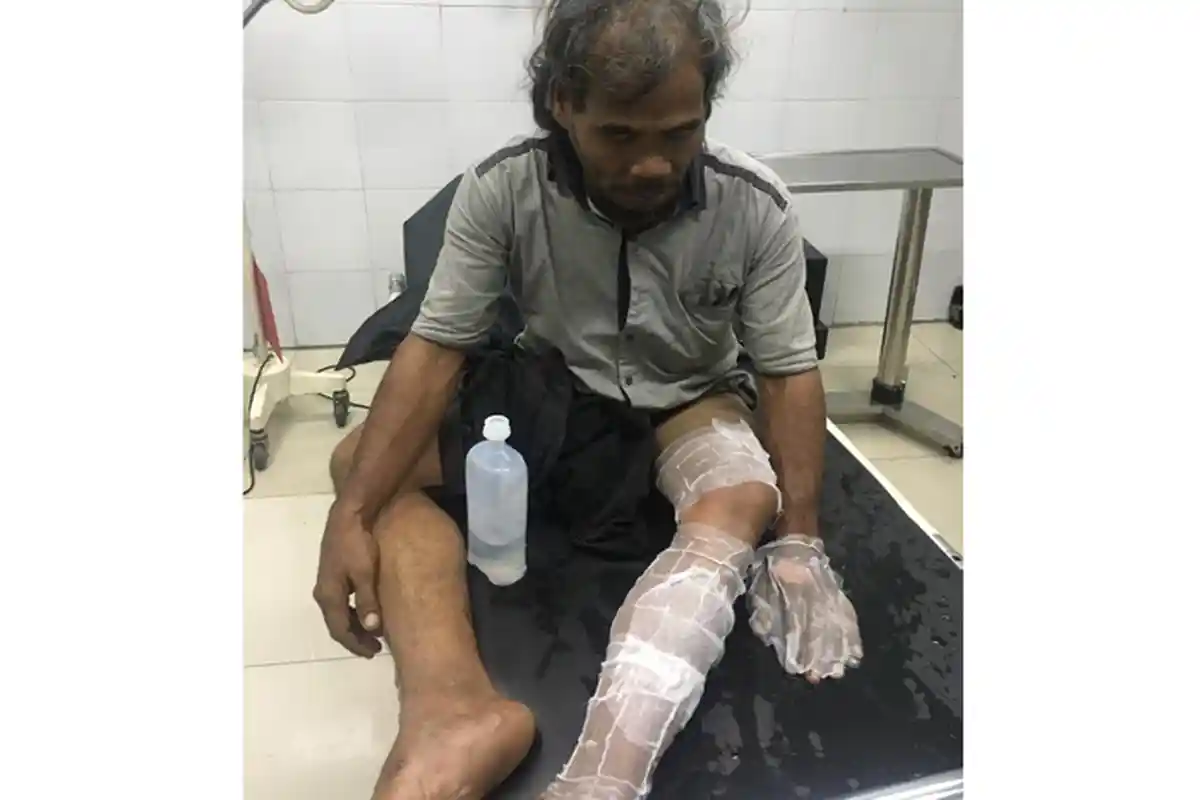 Pengemudi Becak Bermotor Terbakar saat Menyalakan Becaknya setelah Mengisi BBM di SPBU