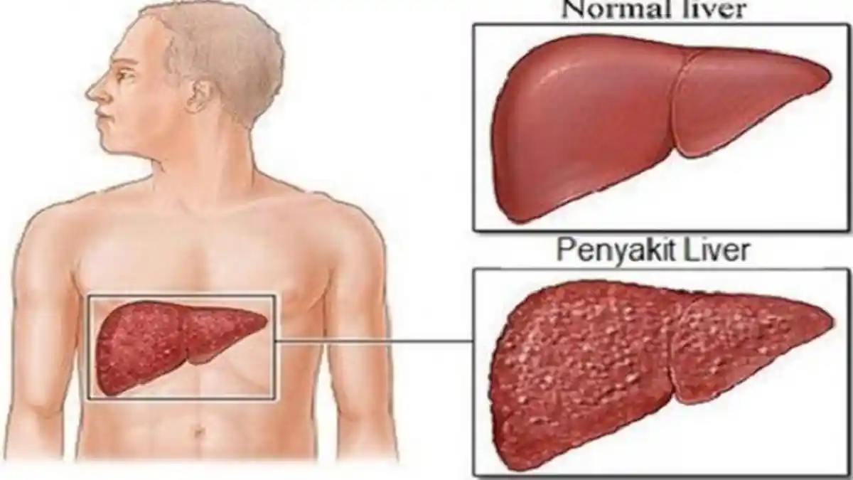 Gejala Penyakit Liver, Termasuk Gatal-gatal di Malam Hari, Begini Penjelasan Ahli
