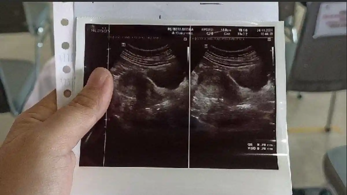 Istri Temukan Foto USG di Laci, Terungkap Rahasia Besar Sang Suami dengan Adik Kandungnya